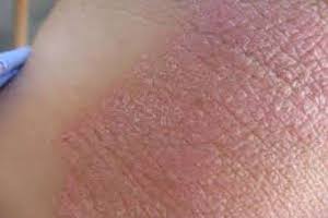 Immagine dermatologia clinica Dott.ssa Beatrice Pietricola